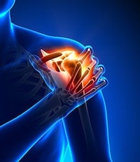 Shoulder Impingement Syndrome Personal Injury Claims